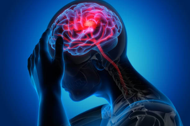 Read more about the article Understanding Stroke: Symptoms, Causes, and Prevention